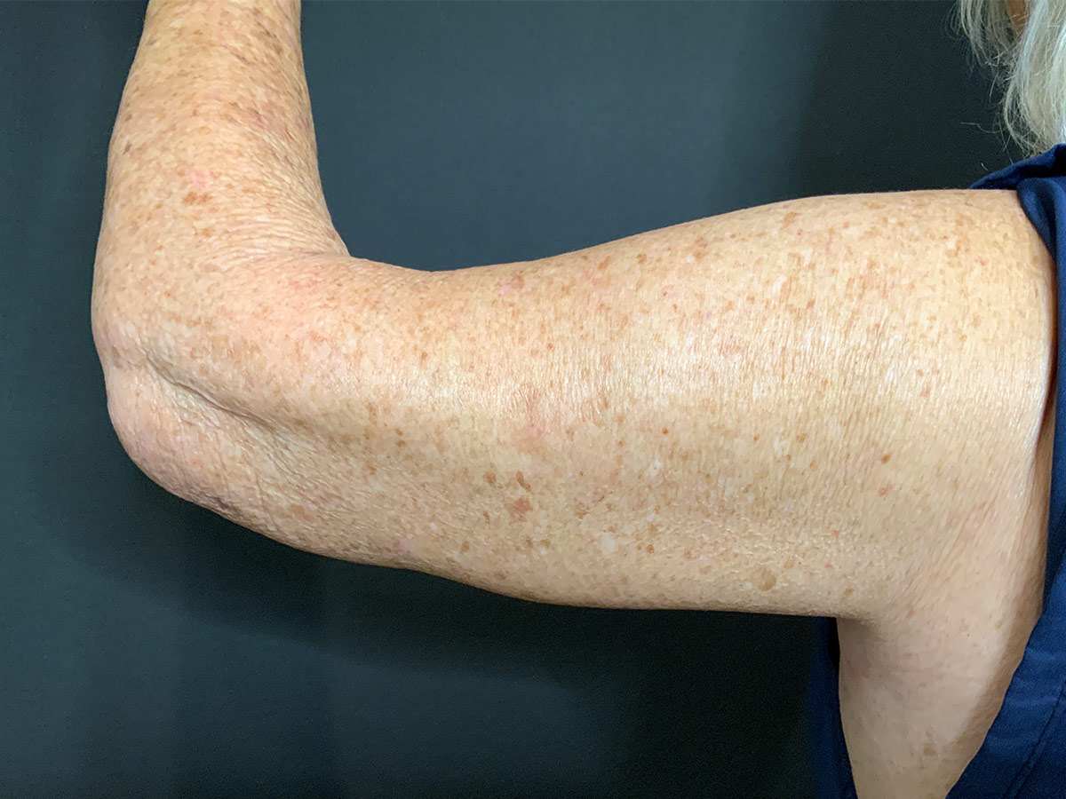 Case--9240 | After Brachioplasty