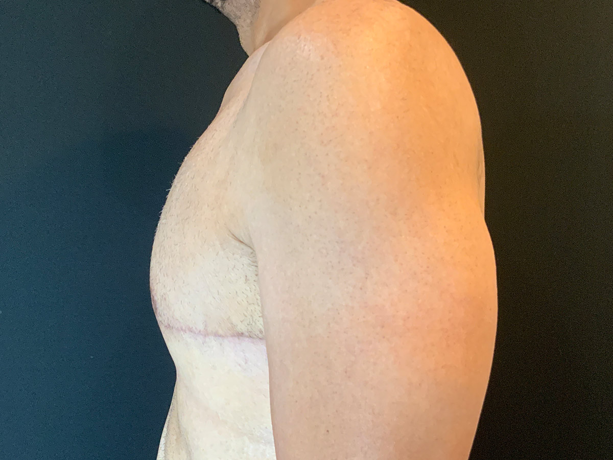 Case--5672 | After Gynecomastia 2