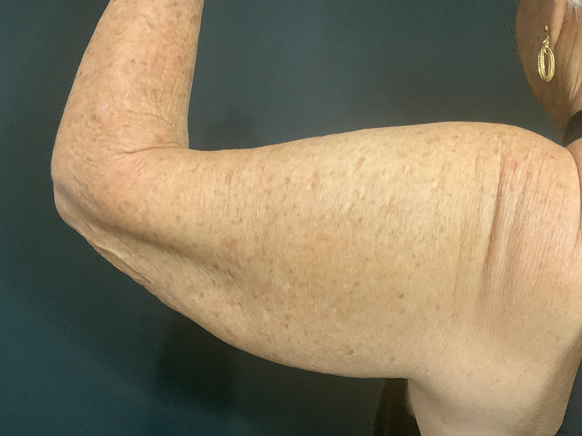 Case--9240 | Before Brachioplasty