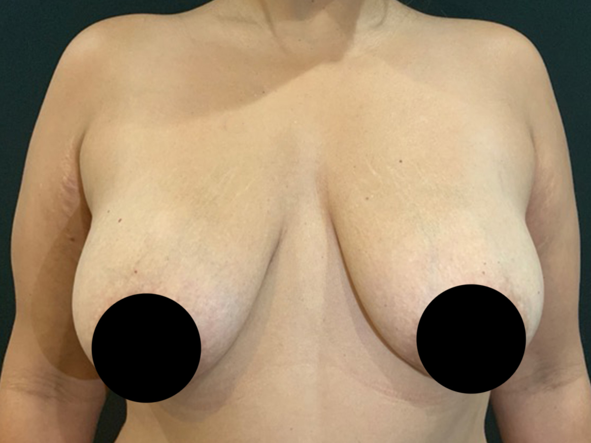 Case--9221 | Before Breast Lift