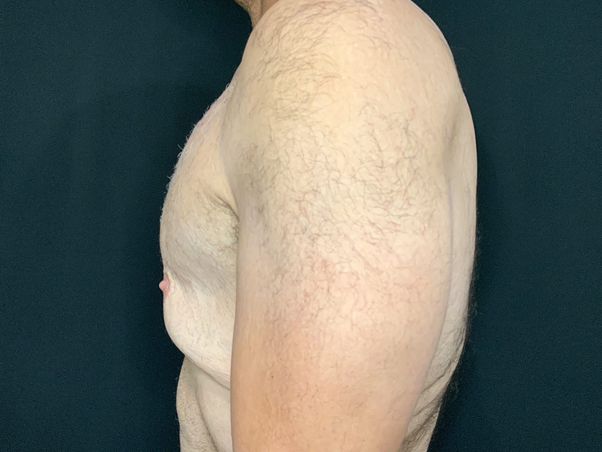 Case--5672 | Before Gynecomastia 2