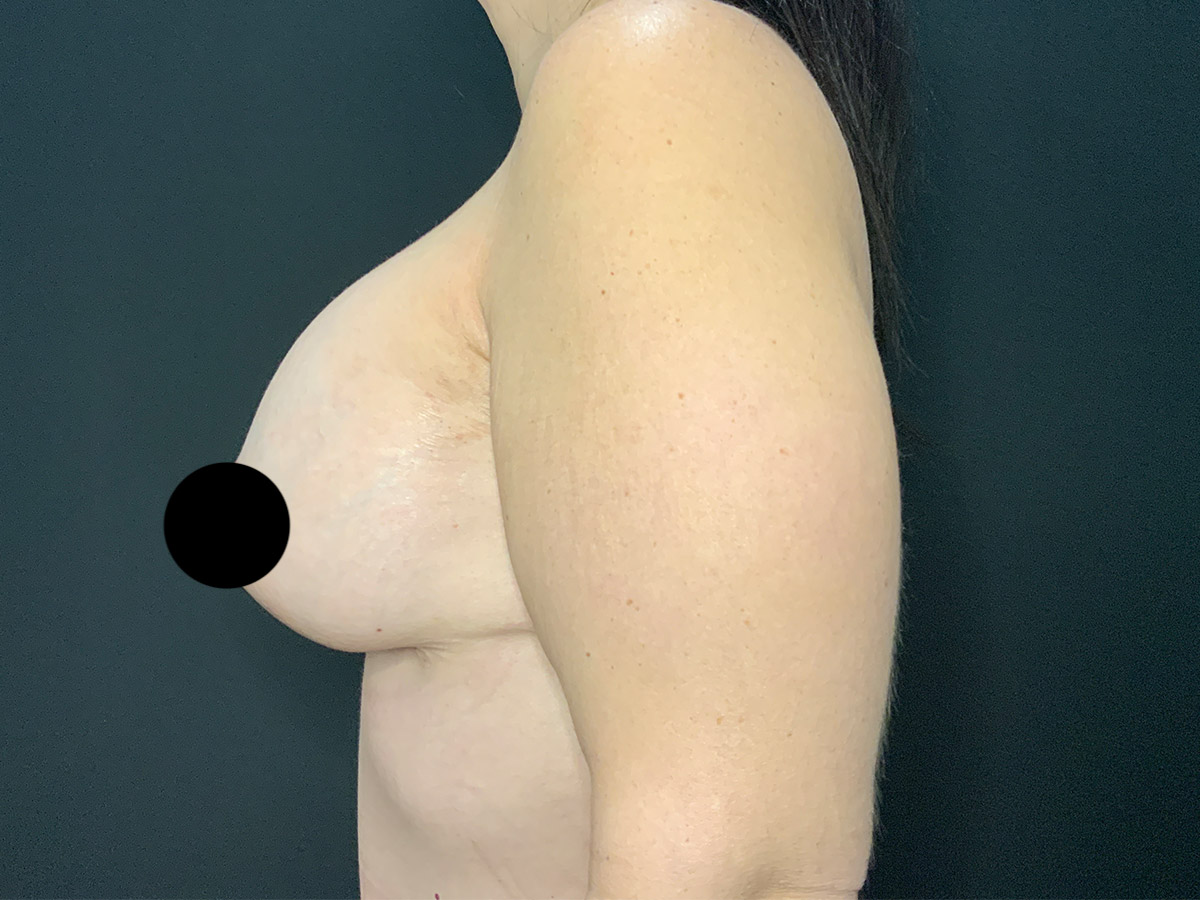 Case--7927 | After Breast Augmentation + Lift 2