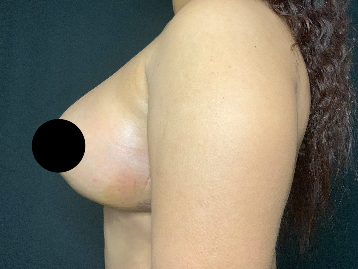 Case--9769 | After Breast Reduction 2