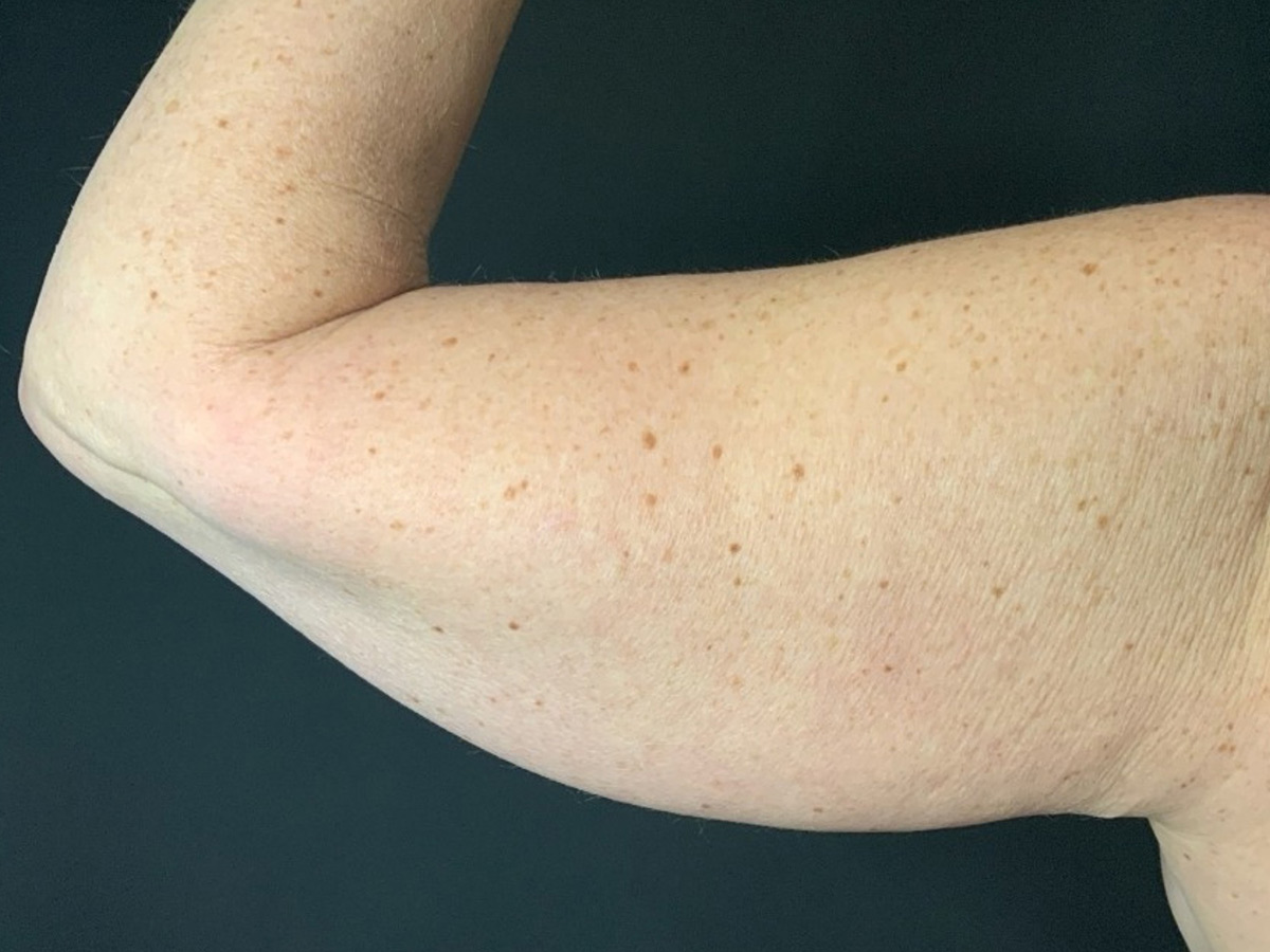 Case--3008 | Before Brachioplasty