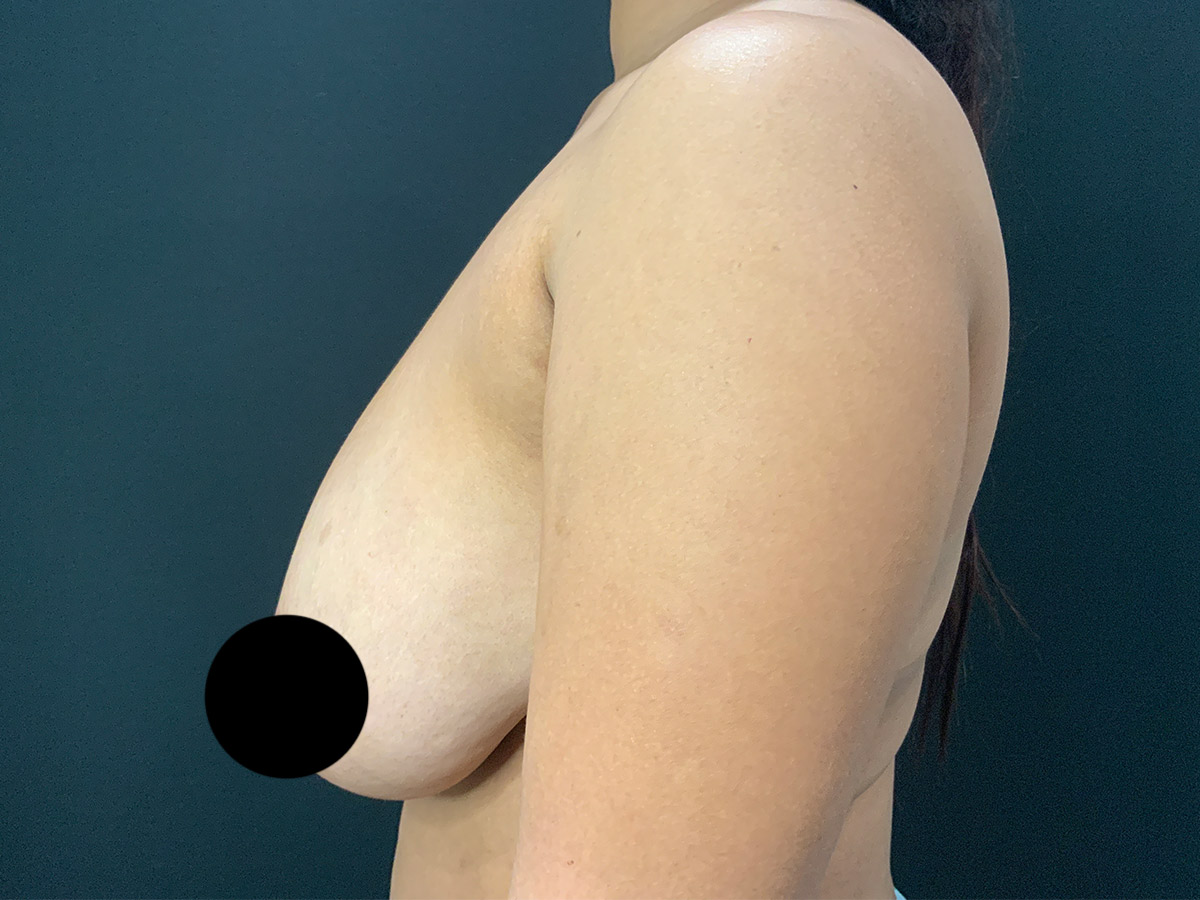 Case--9769 | Before Breast Reduction 2