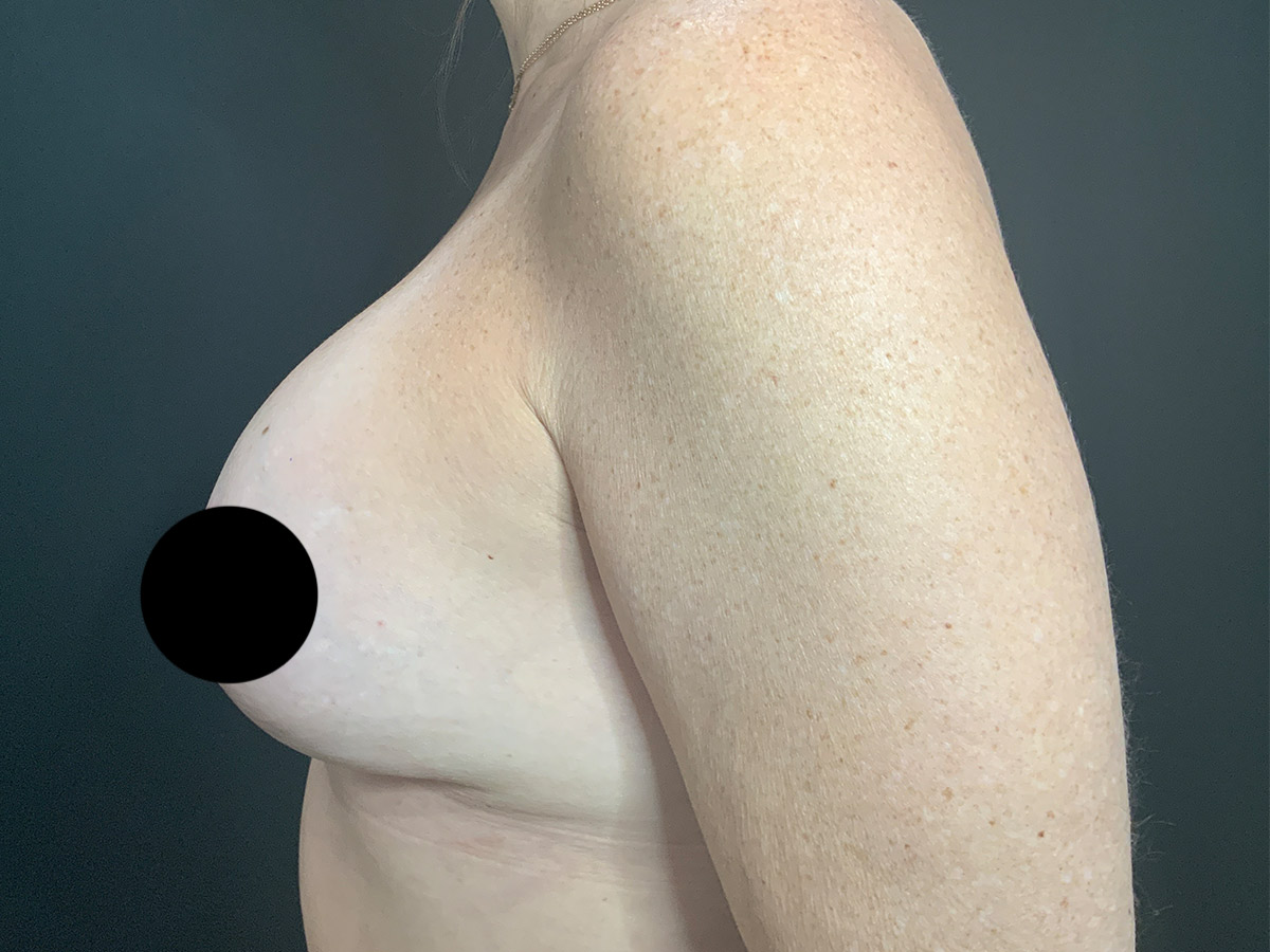 Case--4534 | After Breast Augmentation + Lift 2