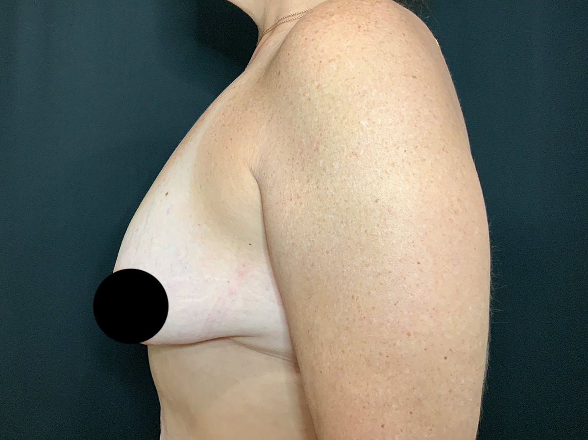 Case--4534 | Before Breast Augmentation + Lift 2