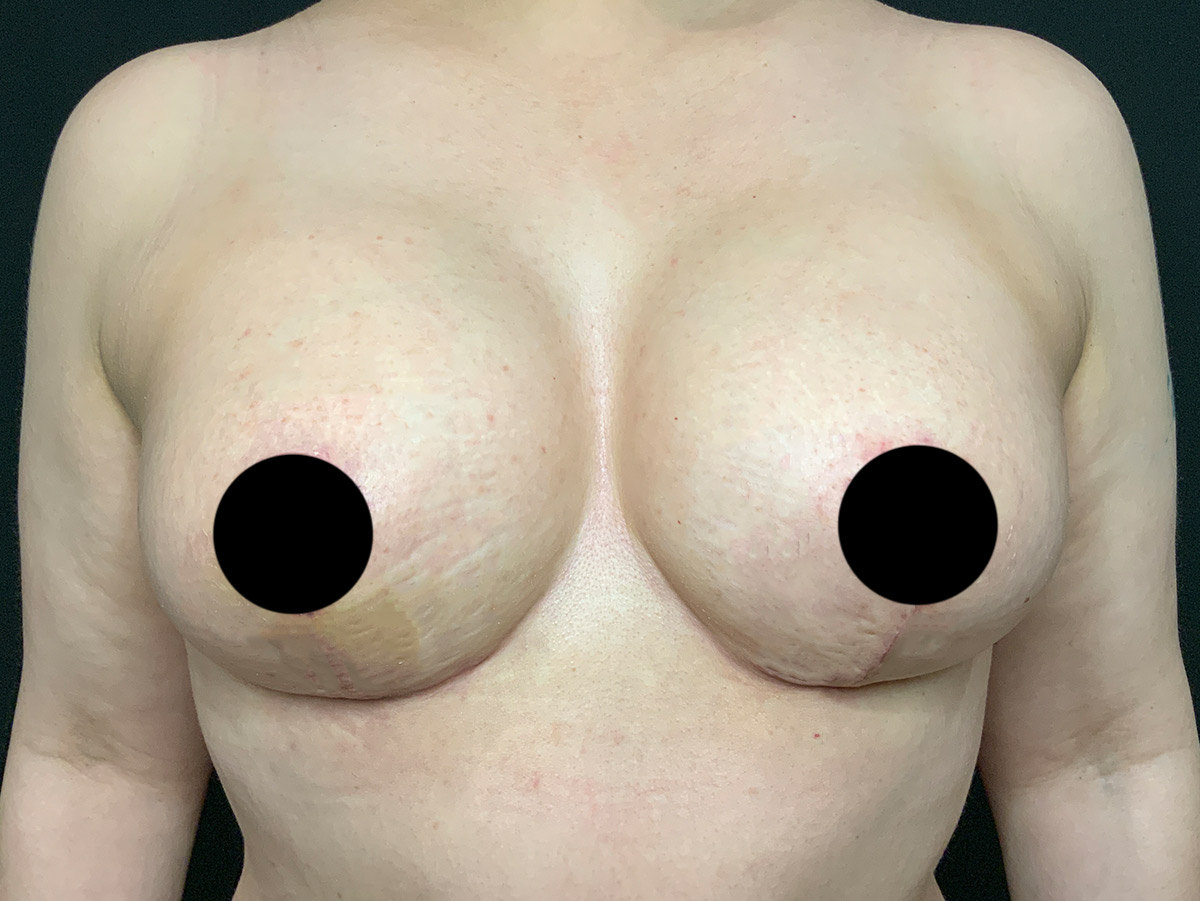 Case--2336 | After Breast Augmentation + Lift