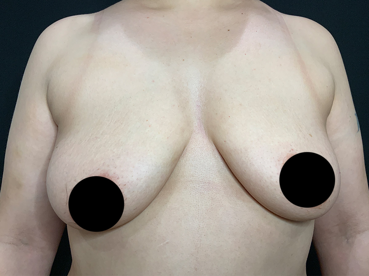 Case--2336 | Before Breast Augmentation + Lift