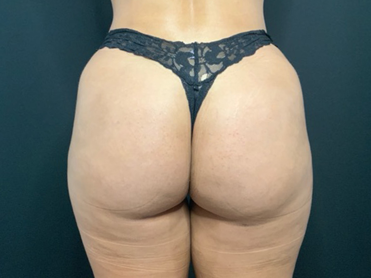 Case--6909 | After Brazilian Butt Lift