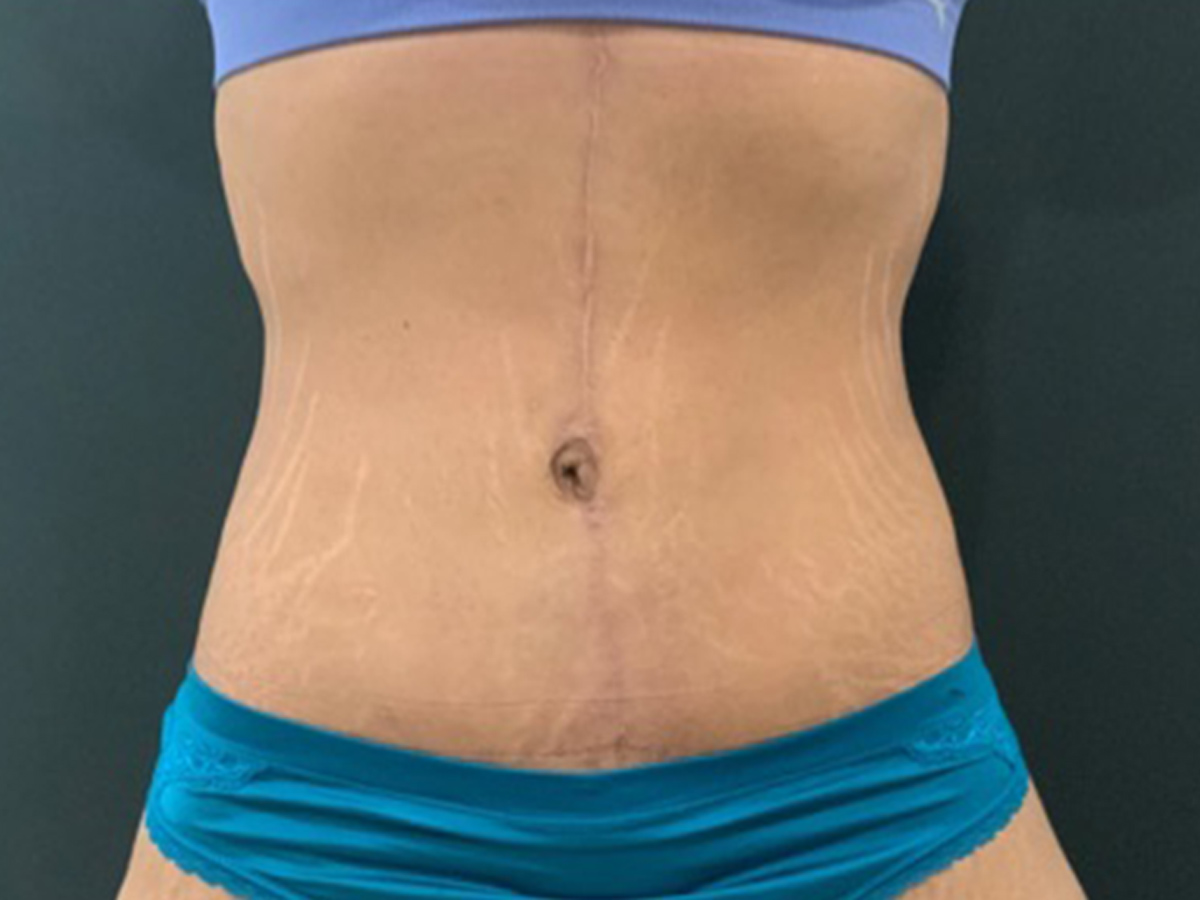 Case--3609 | After Fleur de Lis