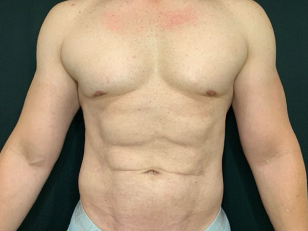 Case--8122 | After Male Liposuction