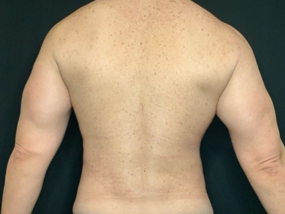 Case--8122 | After Male Liposuction 2