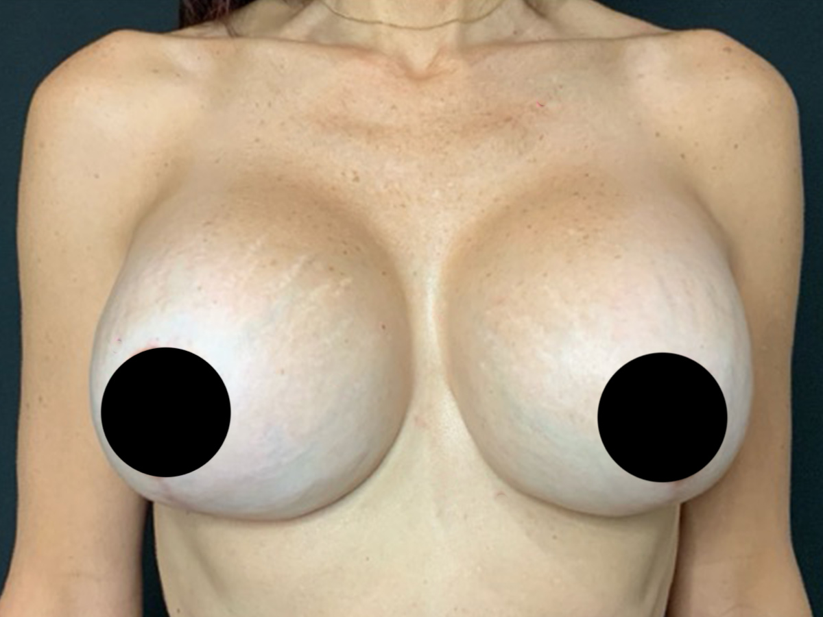 Case--3249 | After Mommy Makeover