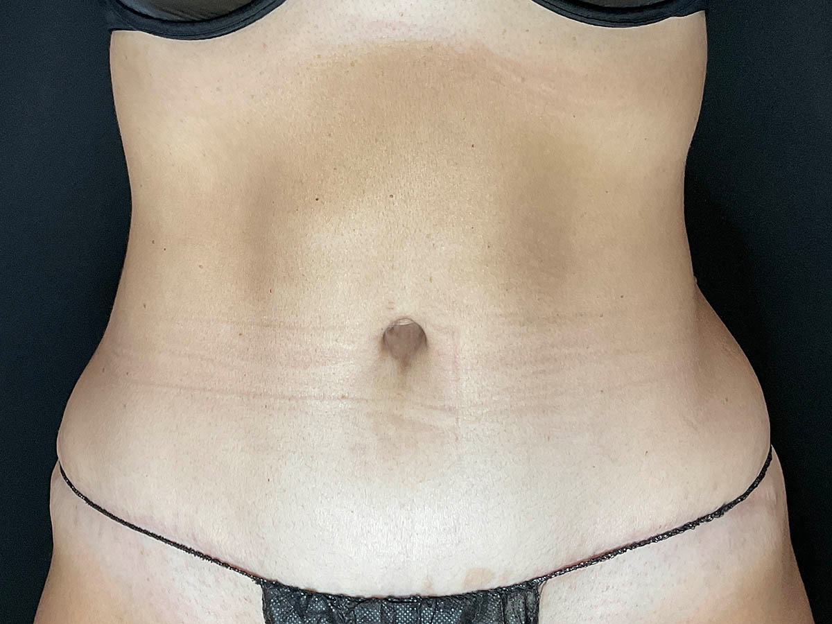 Case--8410 | After Tummy Tuck