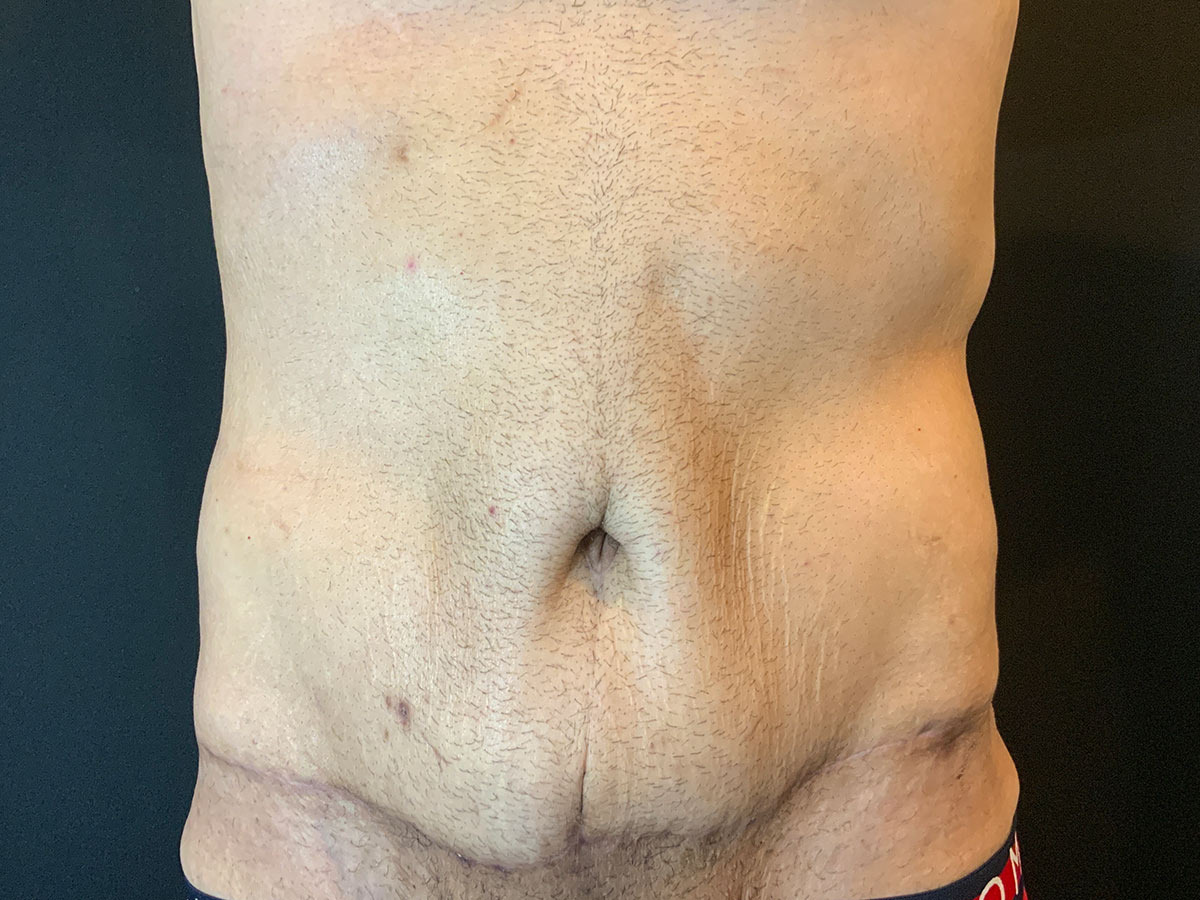 Case--2832 | After Male Tummy Tuck