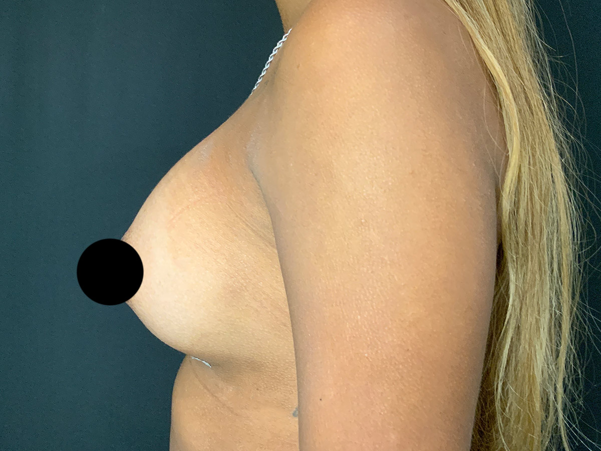 Case--4600 | After Breast Augmentation 2