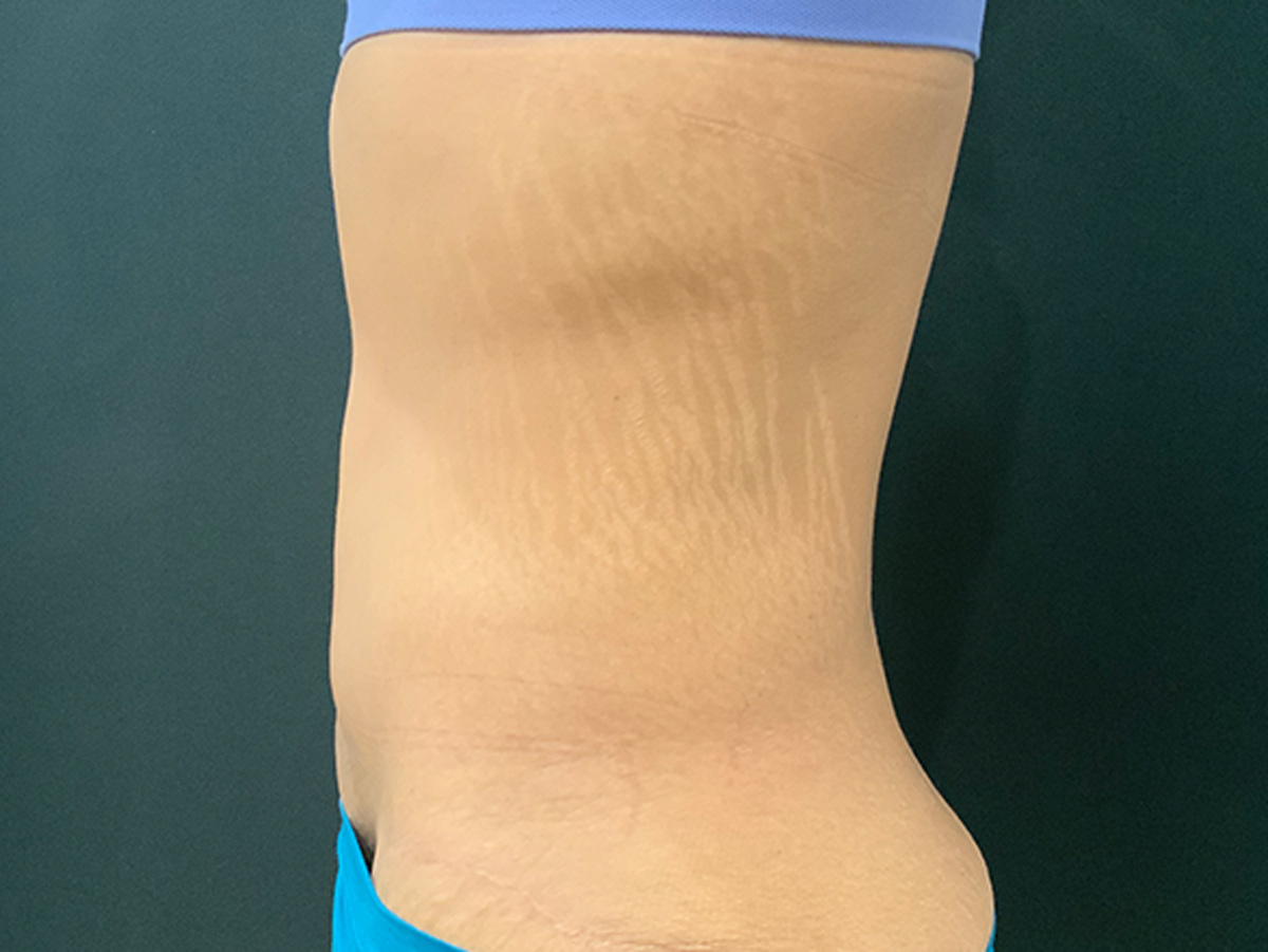 Case--3609 | After Fleur de Lis 2