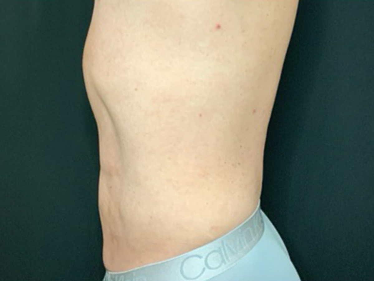 Case--8122 | After Male Liposuction 3