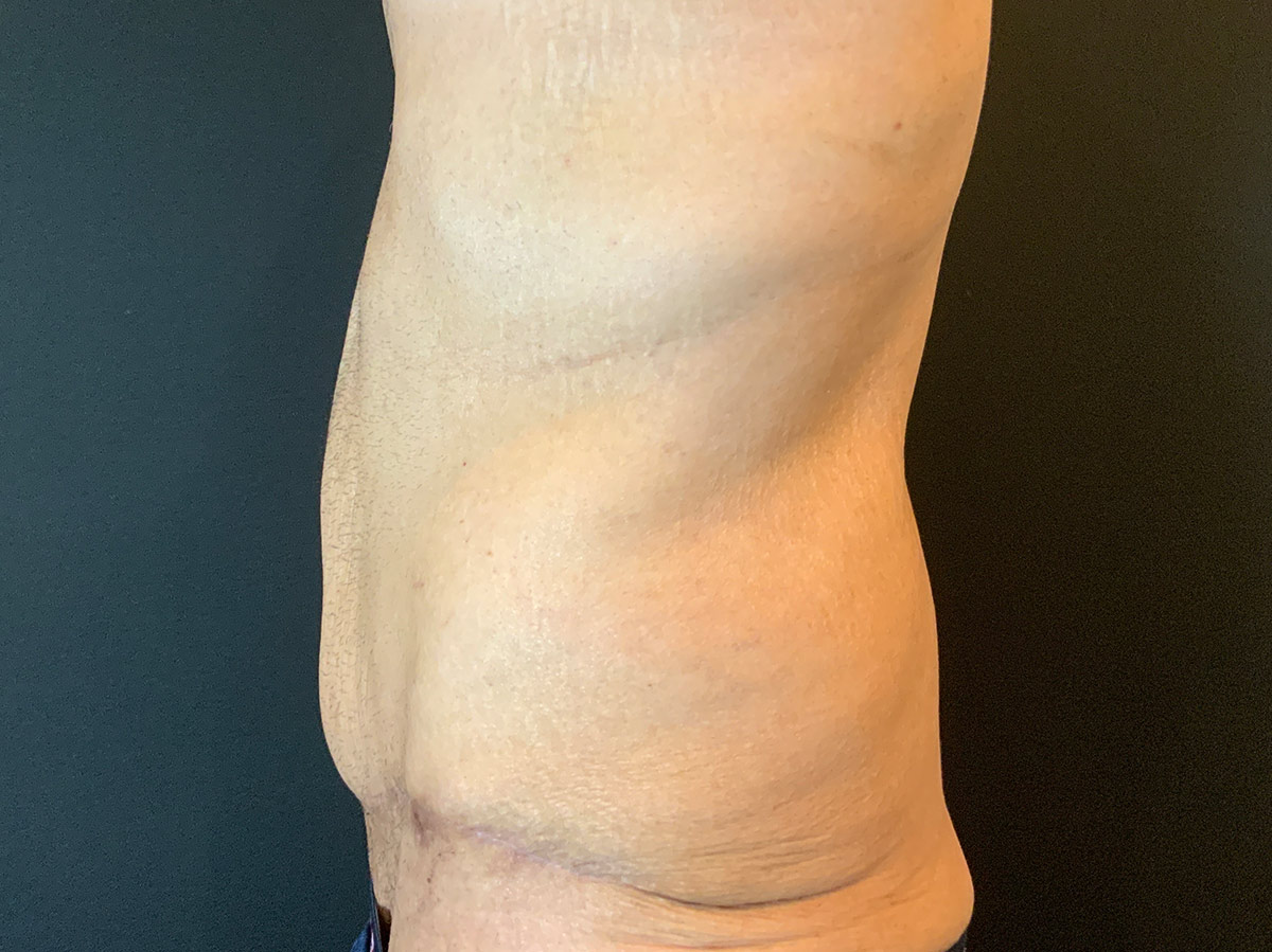 Case--2832 | After Male Tummy Tuck 2