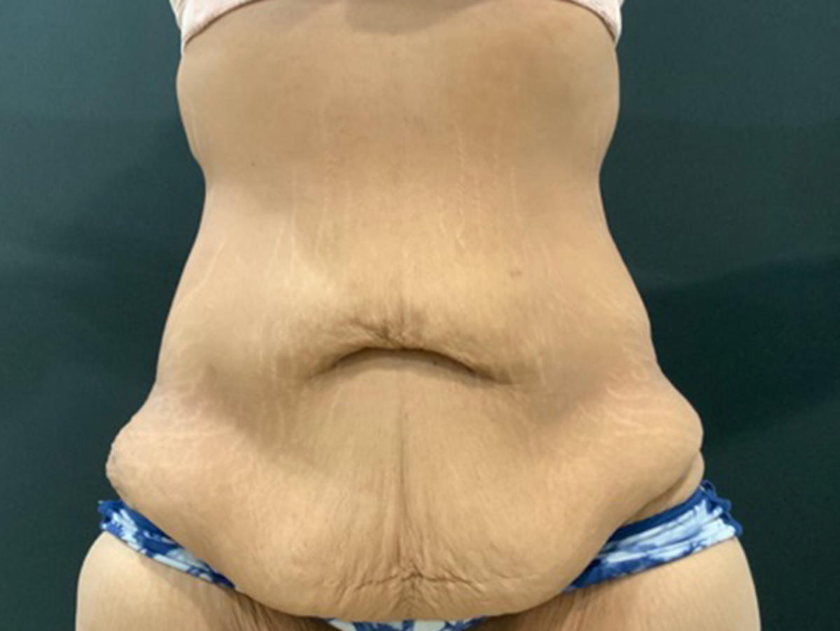 Case--3609 | Before Fleur de Lis