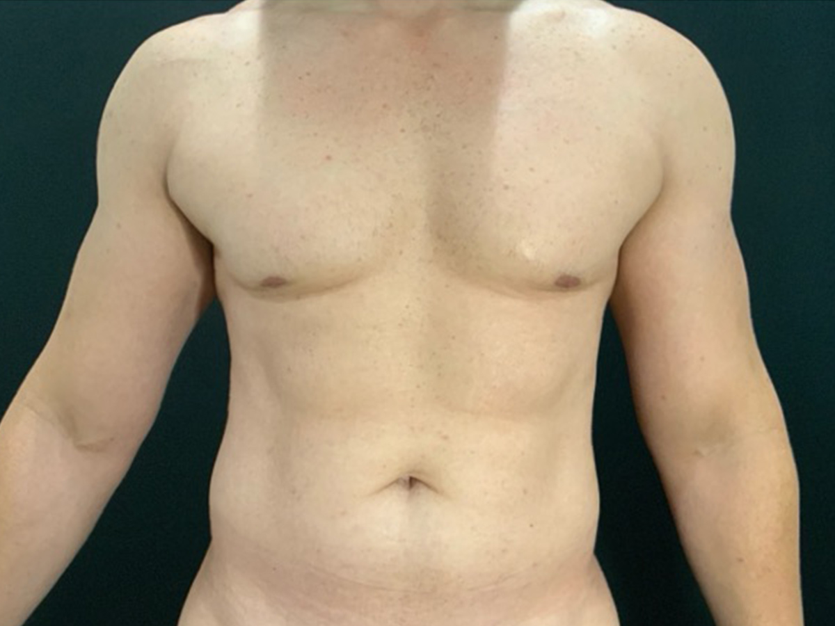 Case--8122 | Before Male Liposuction