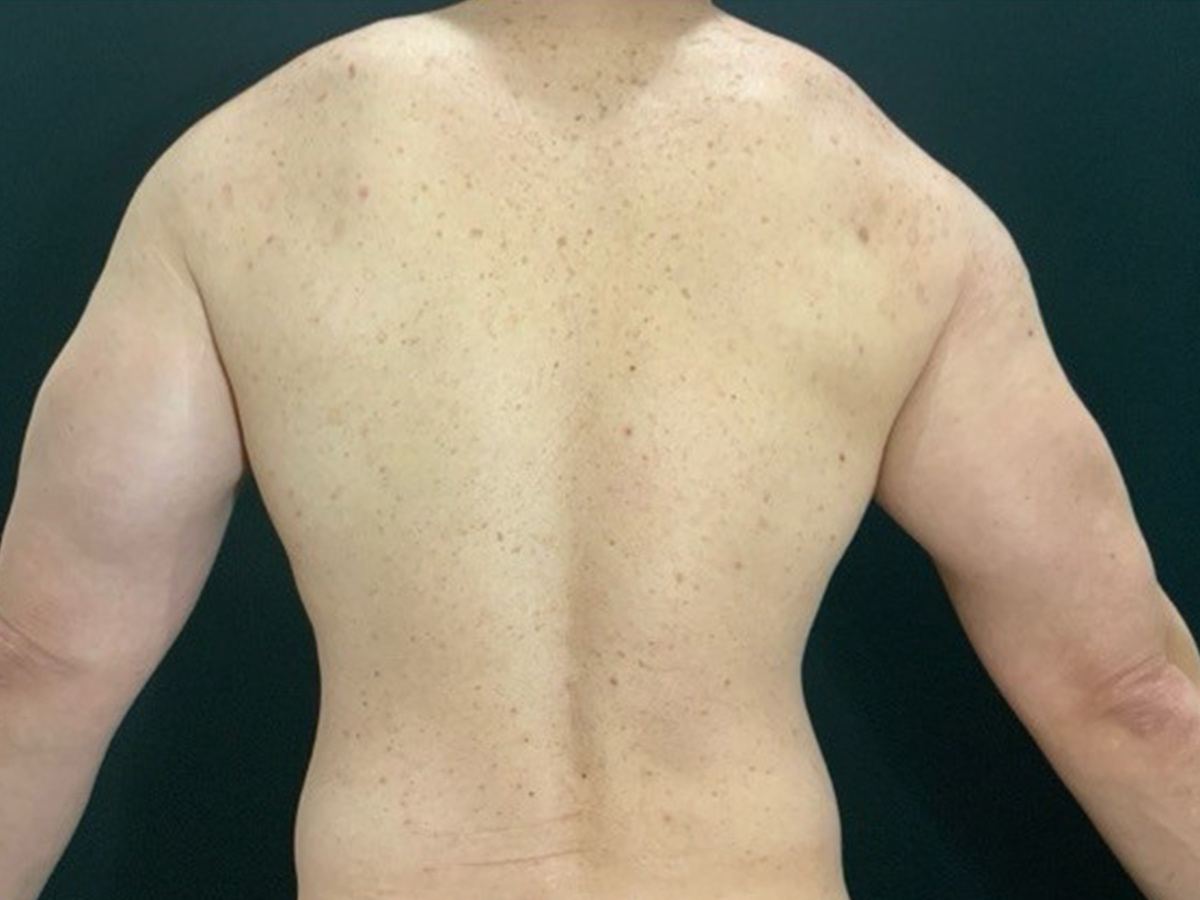 Case--8122 | Before Male Liposuction 2