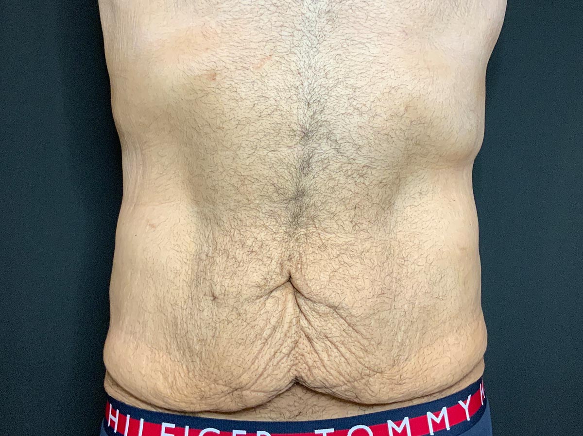 Case--2832 | Before Male Tummy Tuck