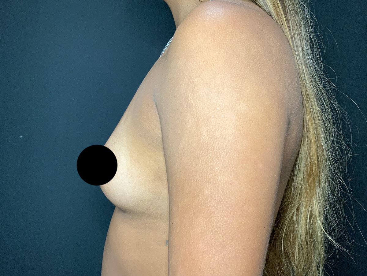 Case--4600 | Before Breast Augmentation 2