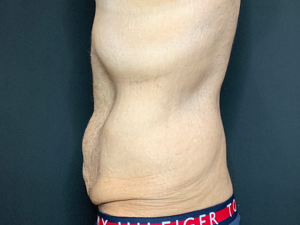 Case--2832 | Before Male Tummy Tuck 2