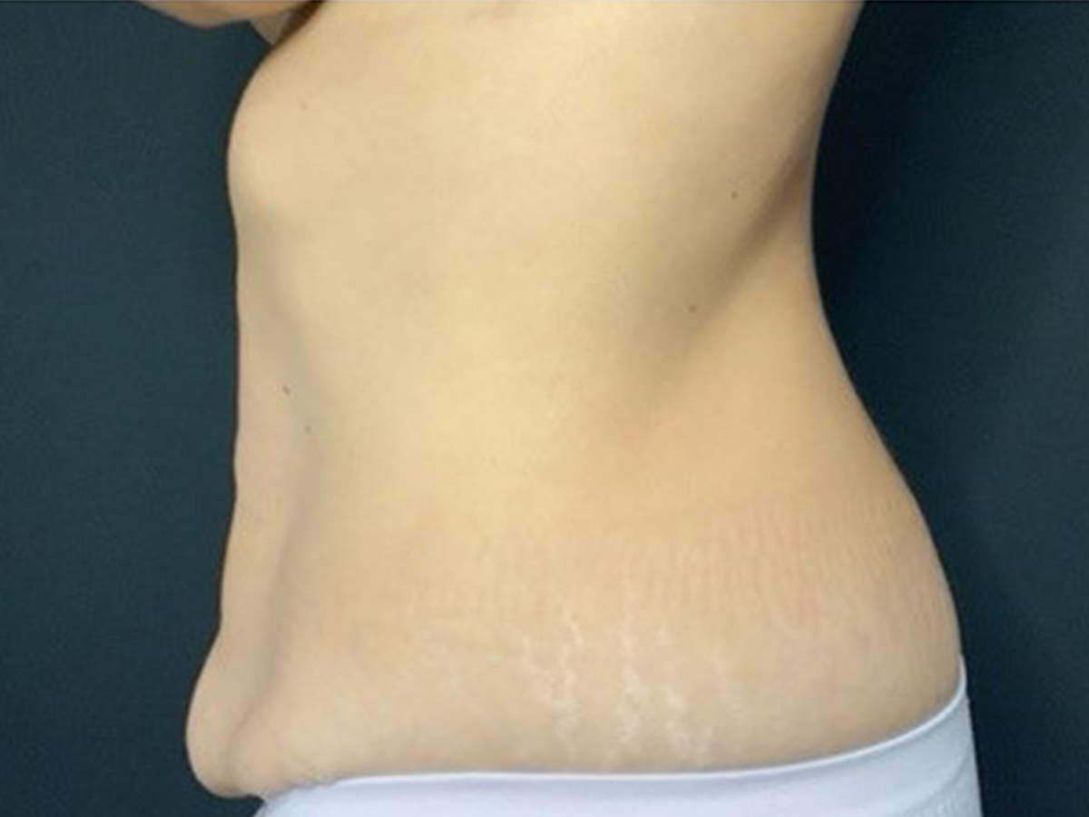 Case--3249 | Before Mommy Makeover 4