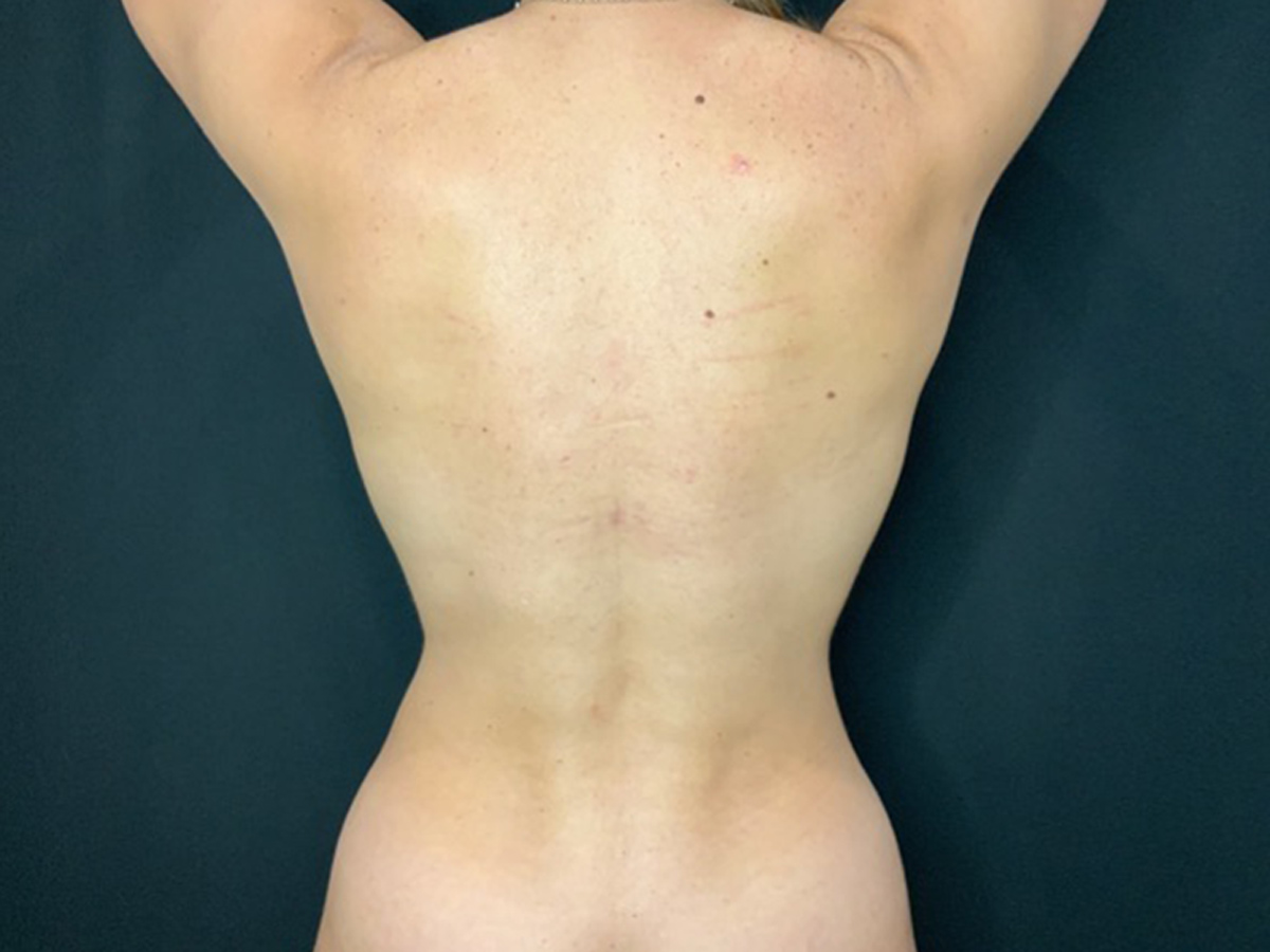 Case--2441 | After Liposuction 2