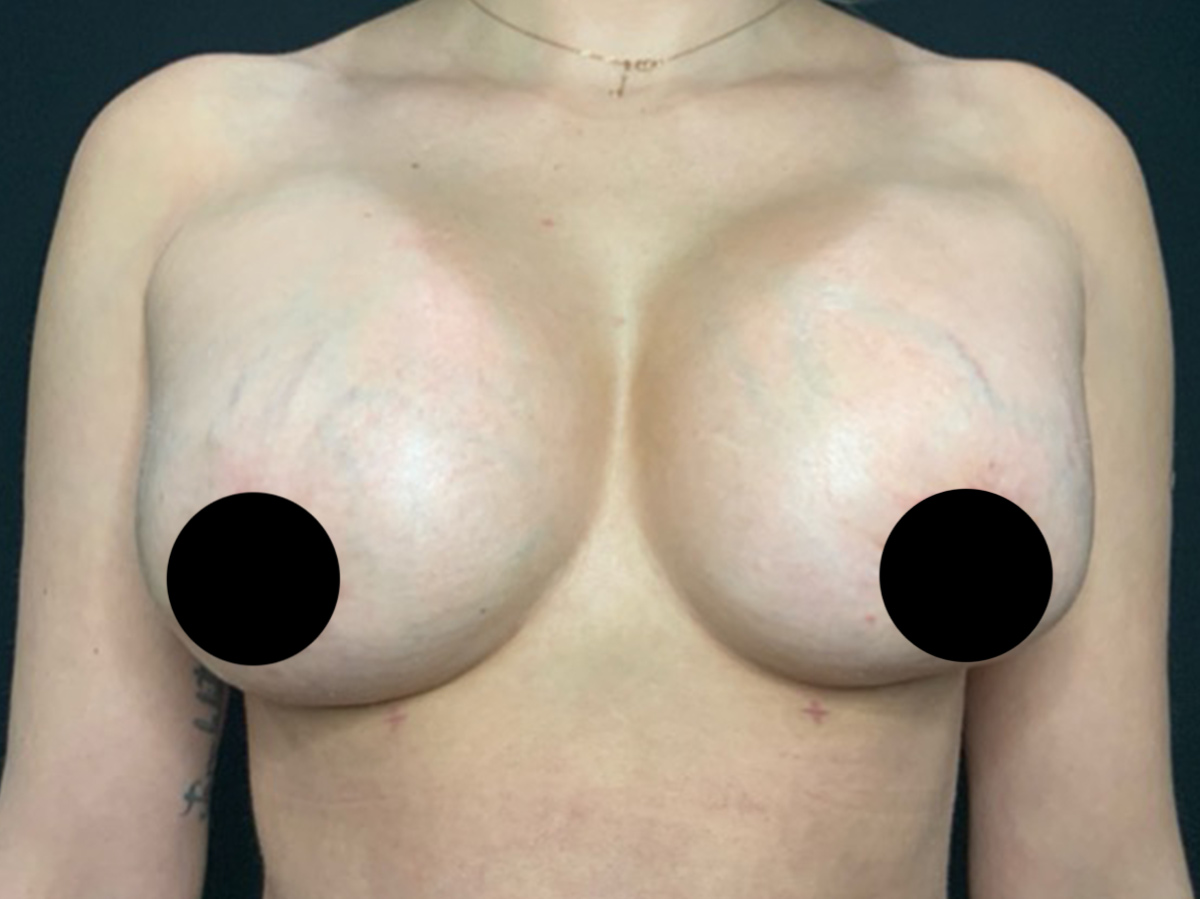 Case--9251 | After Breast Revision