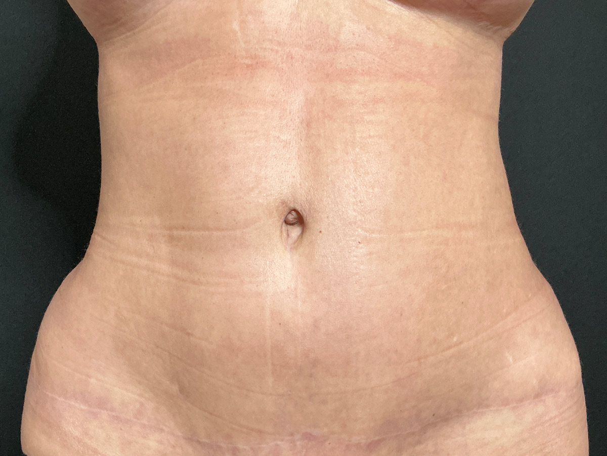 Case--9899 | After Tummy Tuck