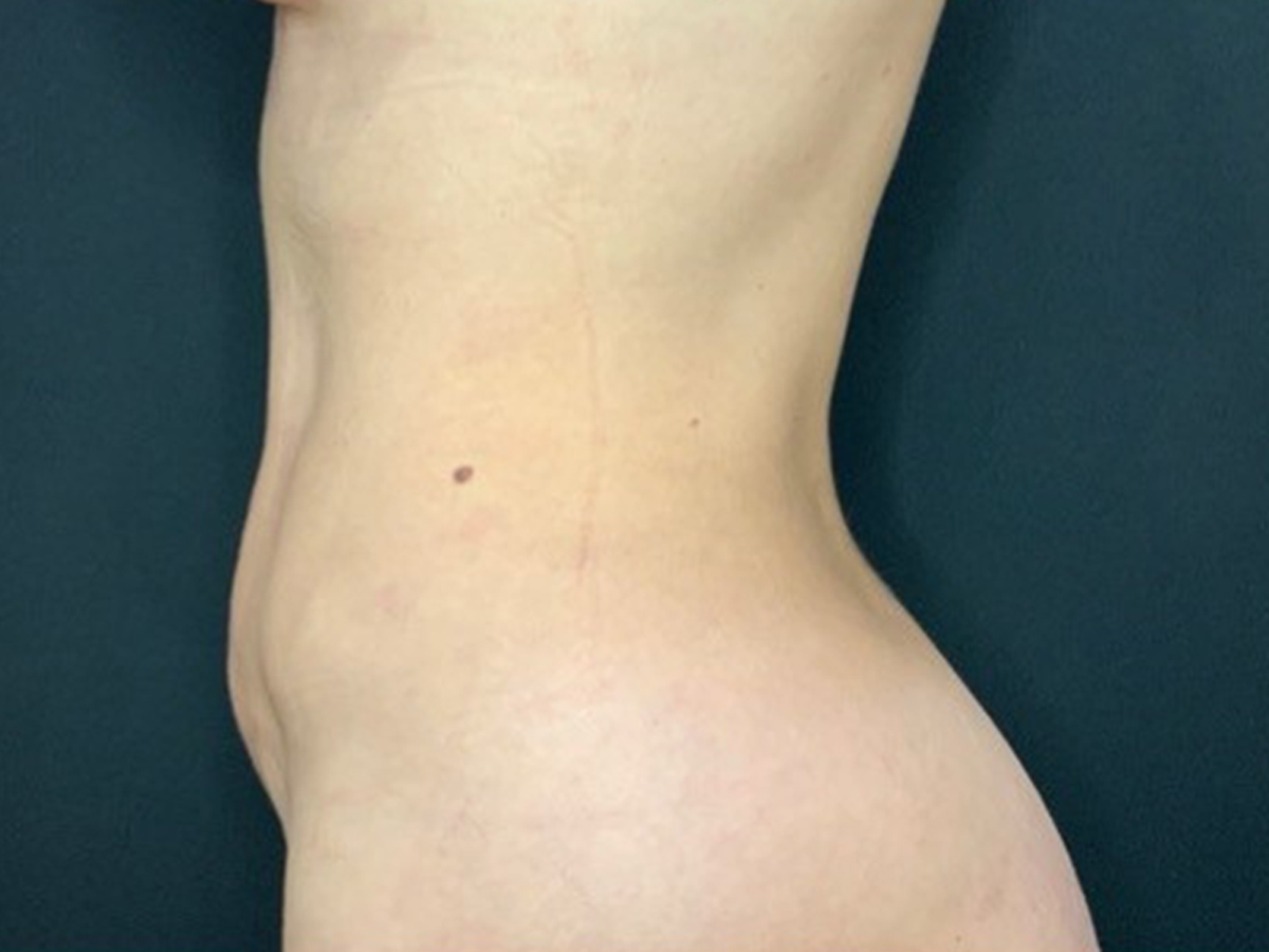 Case--2441 | After Liposuction 3