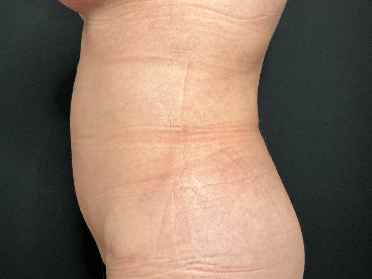 Case--9899 | After Tummy Tuck 2