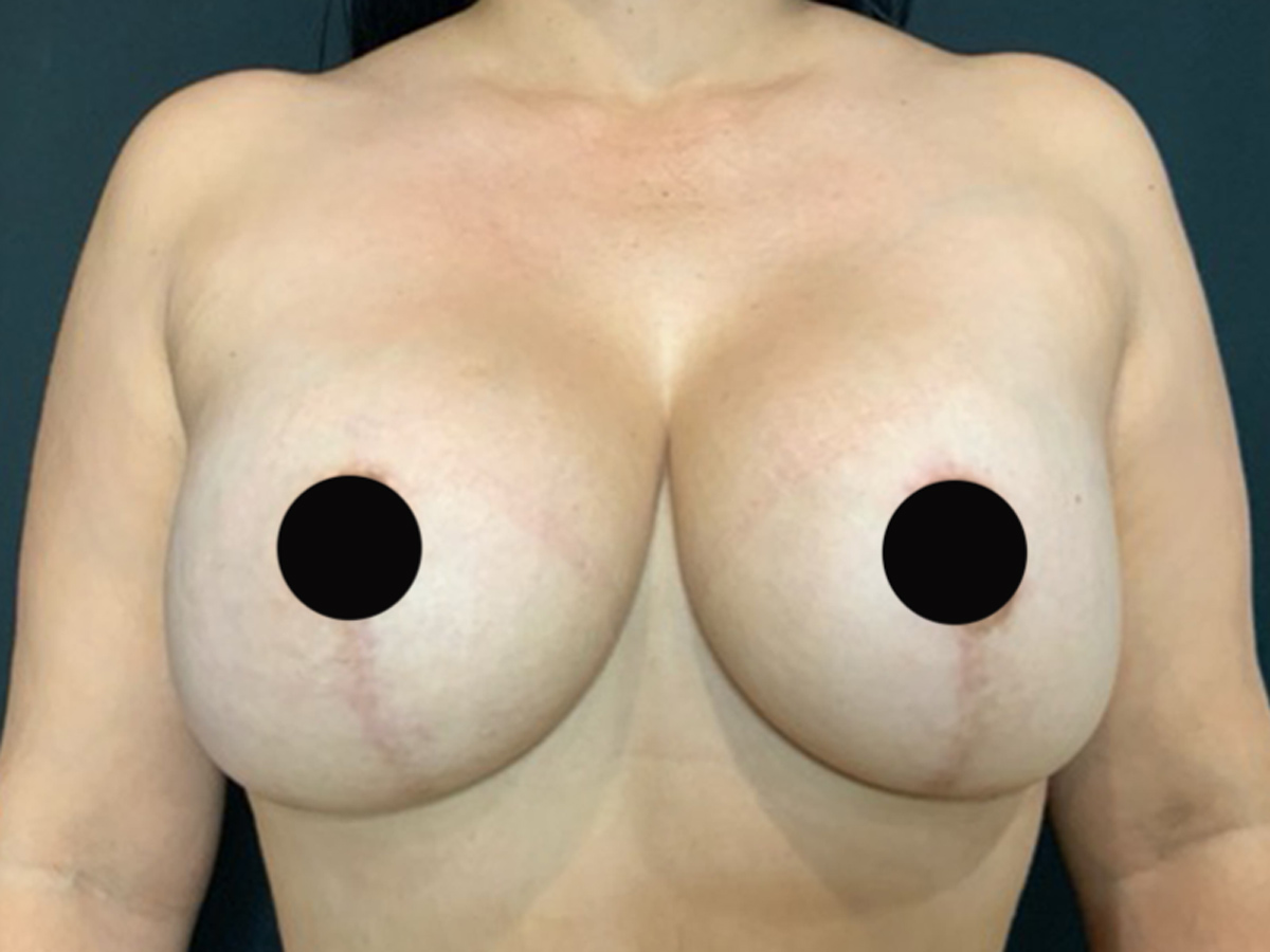 Case--6062 | After Breast Revision