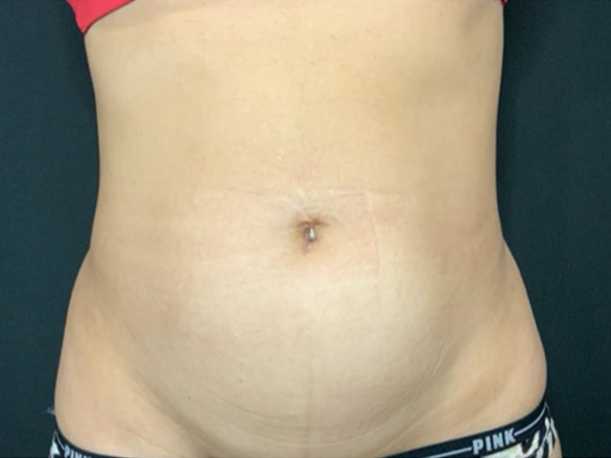 Case--7946 | Before Liposuction