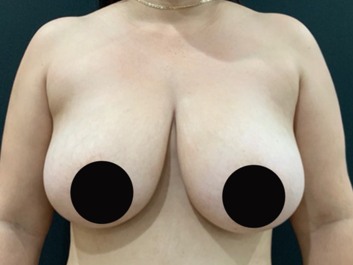 Case--6062 | Before Breast Revision