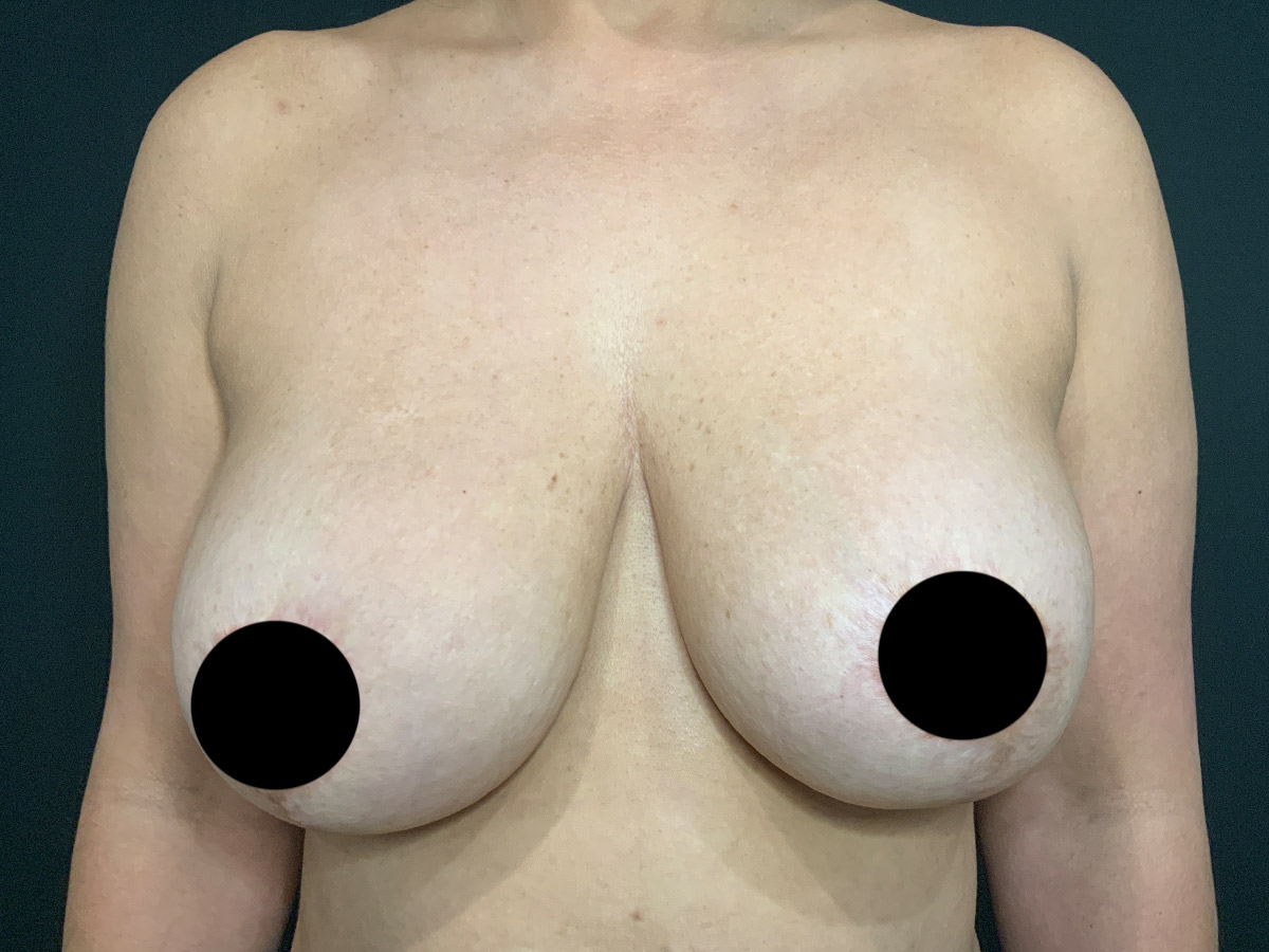 Case--8770 | Before Breast Revision