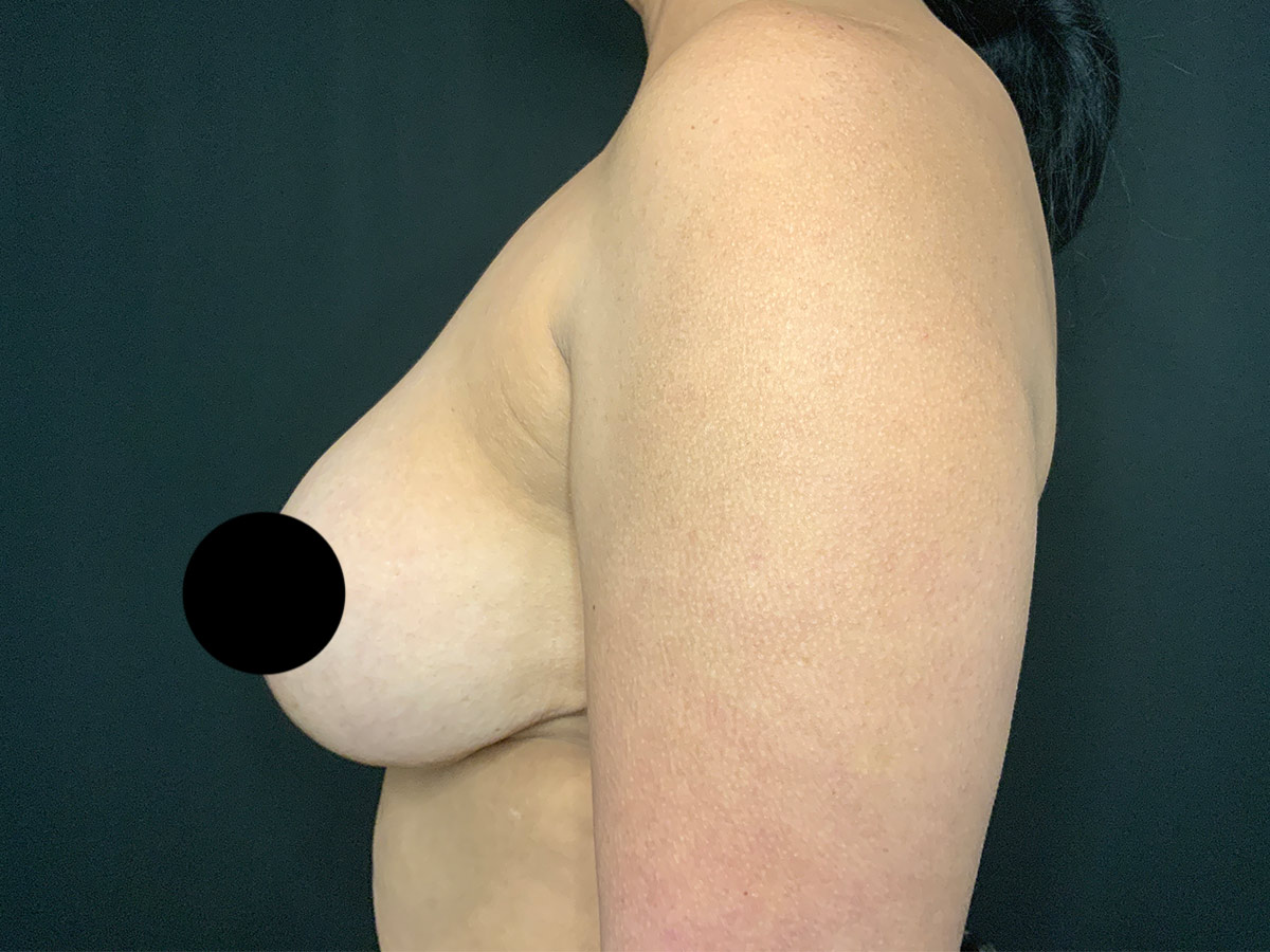 Case--8770 | Before Breast Revision 2