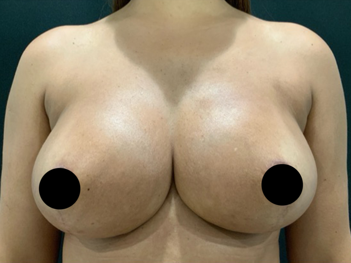 Case--1571 | After Breast Revision