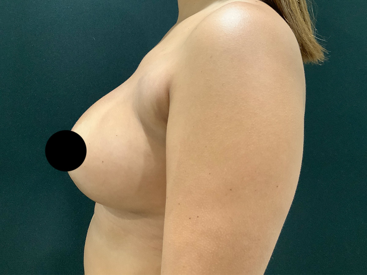 Case--1571 | After Breast Revision 2