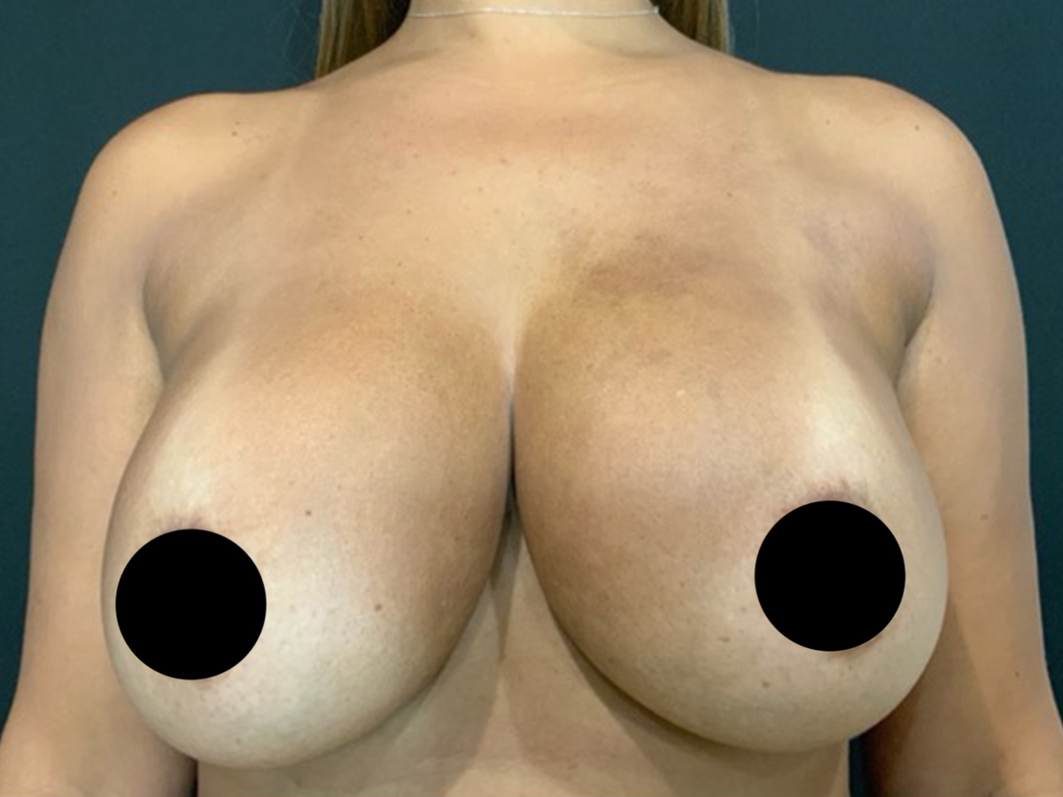 Case--1571 | Before Breast Revision