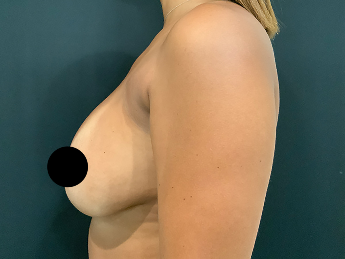 Case--1571 | Before Breast Revision 2