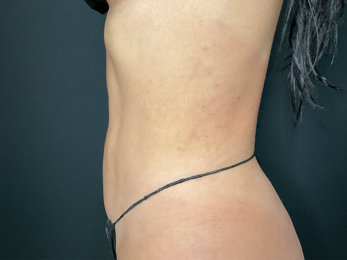 Case--1845 | After Liposuction 3