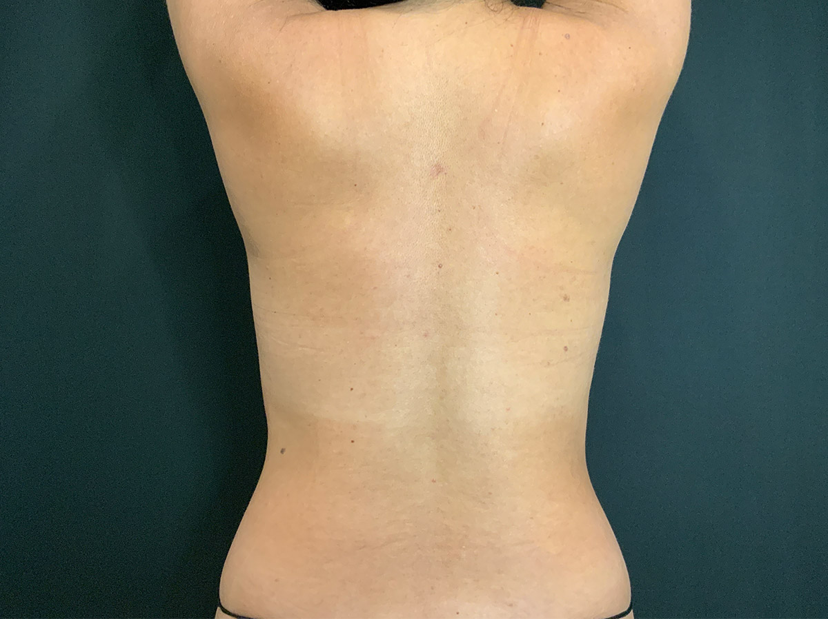 Case--1845 | Before Liposuction 2