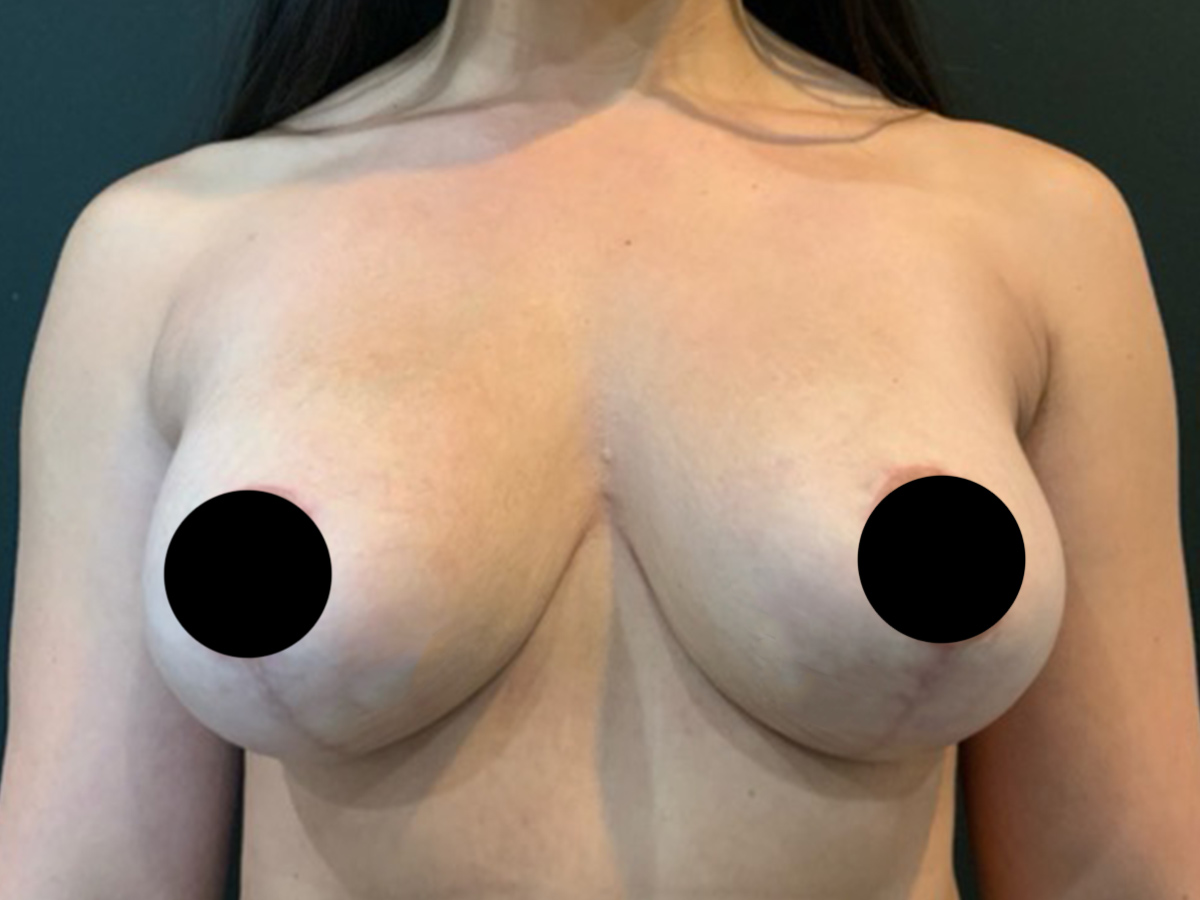 Case--2309 | After Breast Revision