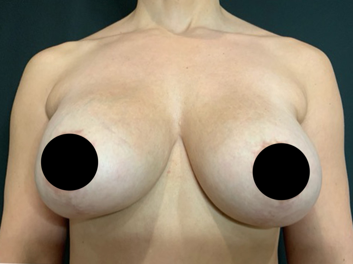 Case--2309 | Before Breast Revision