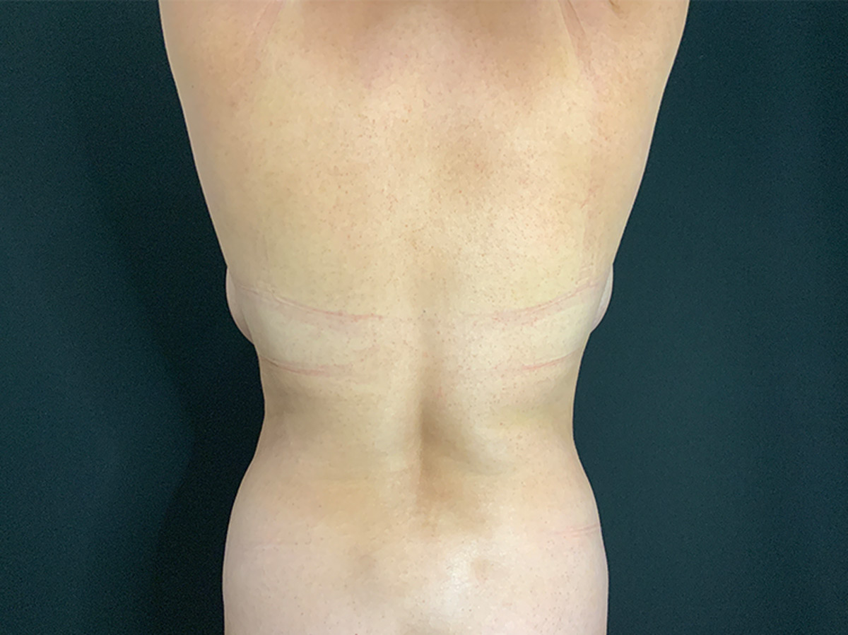 Case--3881 | Before Liposuction 2